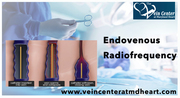 Endovenous Radiofrequency,  Radiofrequency Ablation Veins